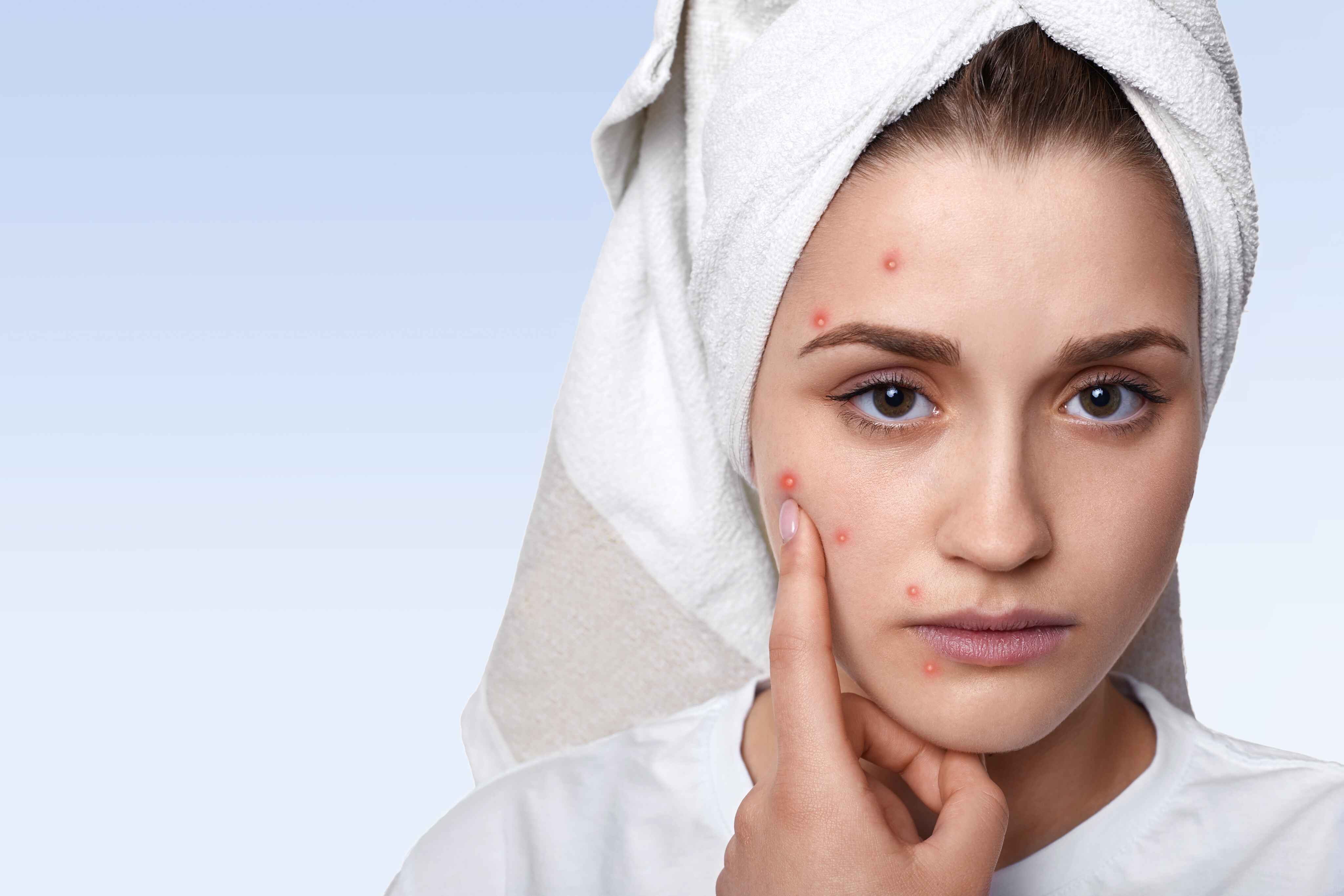 Acne Treatment Clinic